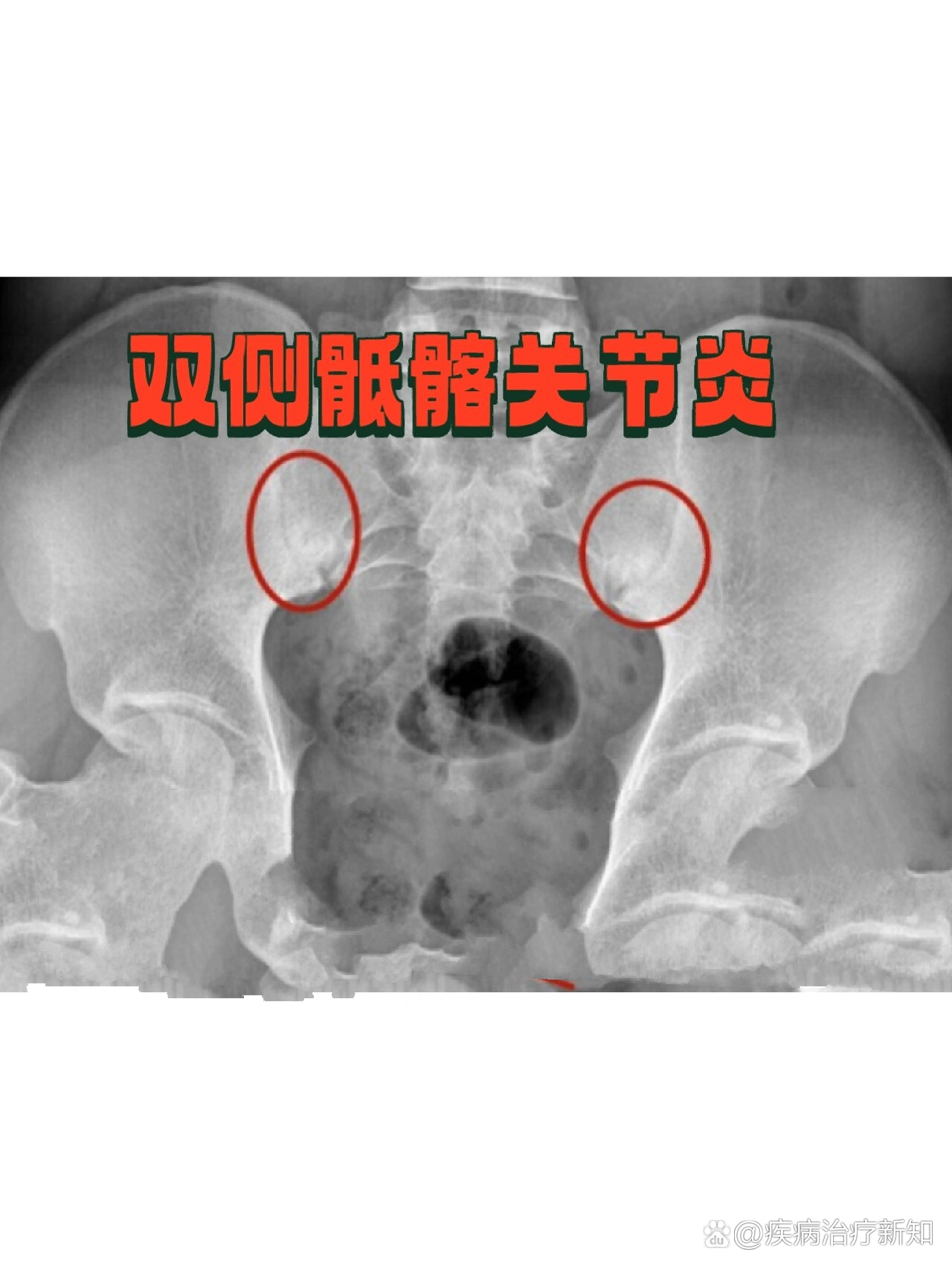 知识分享:骶髂关节炎是什么?