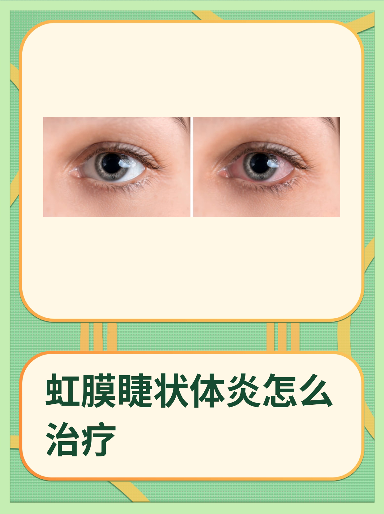 虹膜睫状体炎,需要怎么治疗