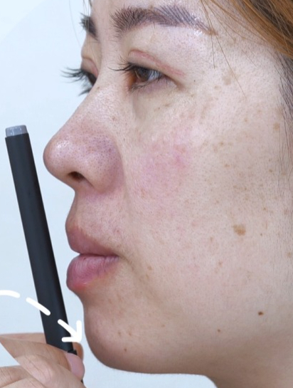 今天看一个垫下巴的案例