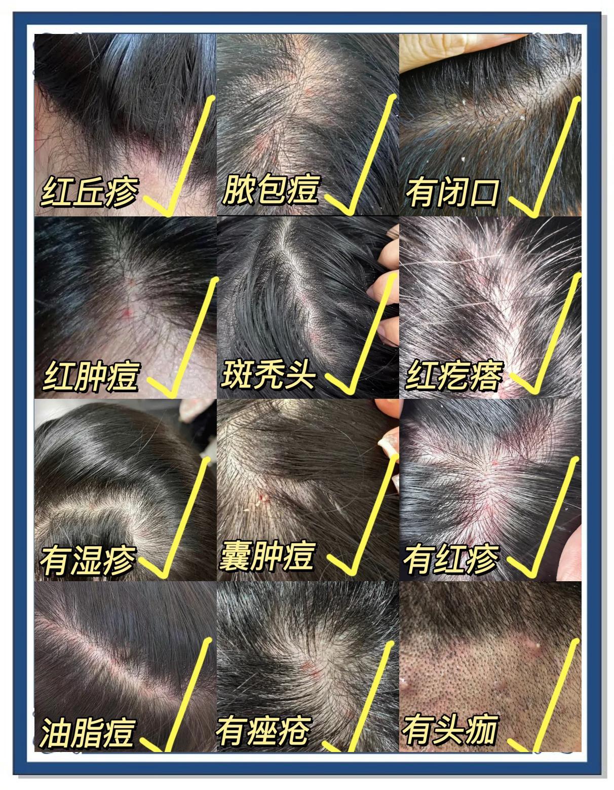 头皮痘痘大揭秘！