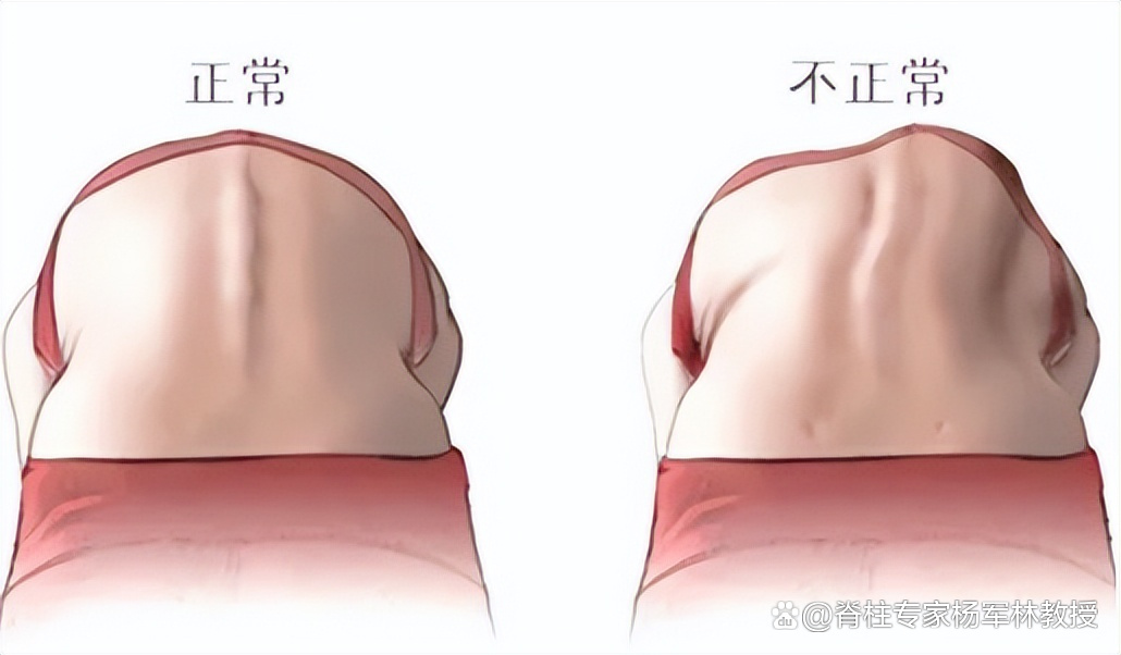 当弯腰时,一侧背部隆起,一侧背部凹陷,一边高一边低,高的一侧就像小