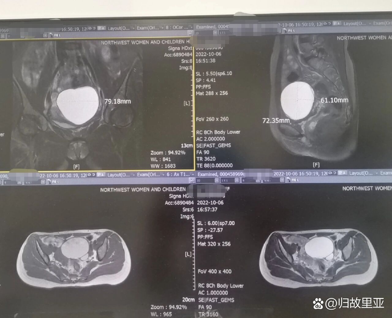 巧克力囊肿穿刺图片