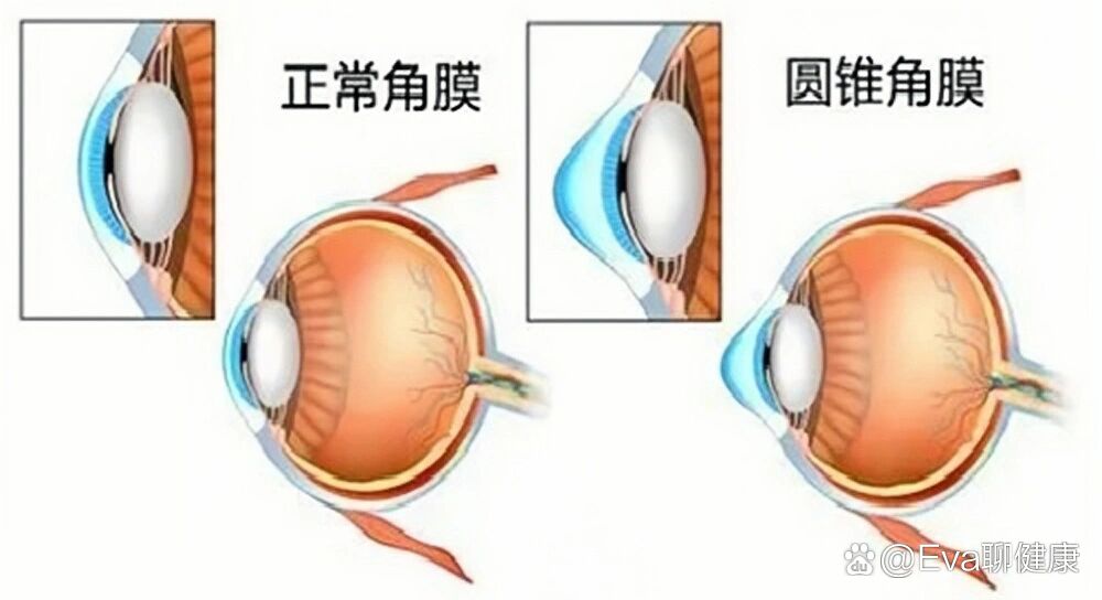 圆锥角膜图图片