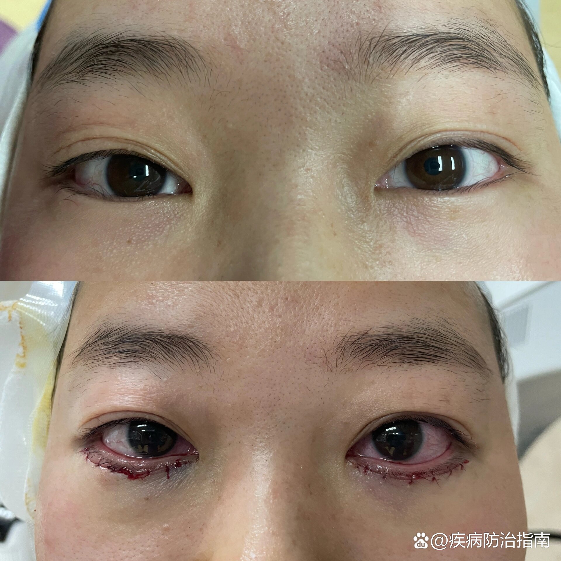睑内翻倒睫