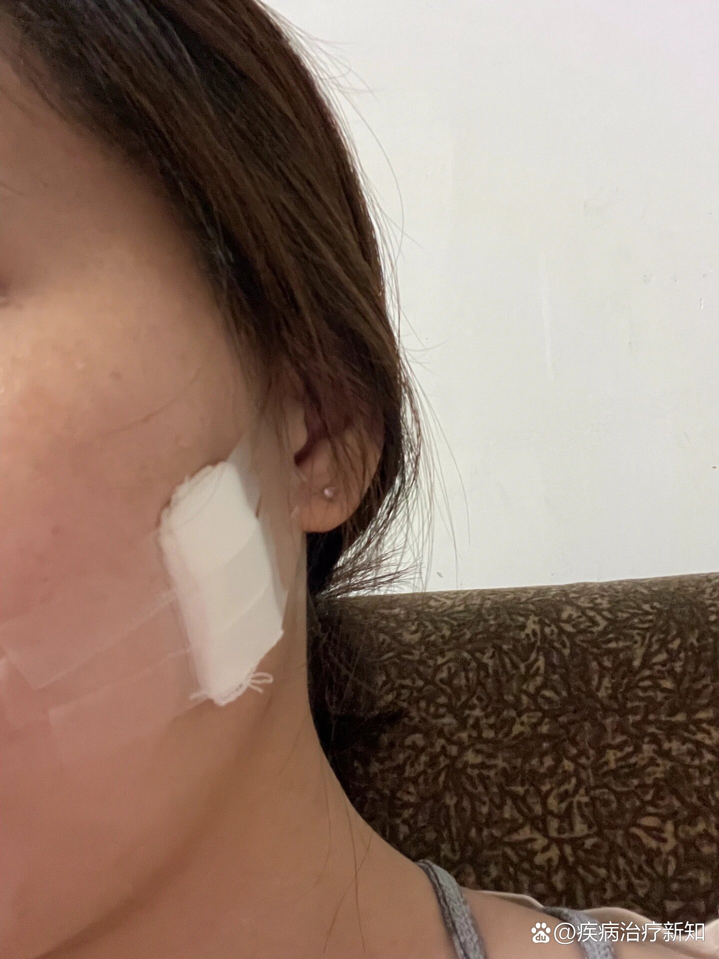 脸部毛母质瘤
