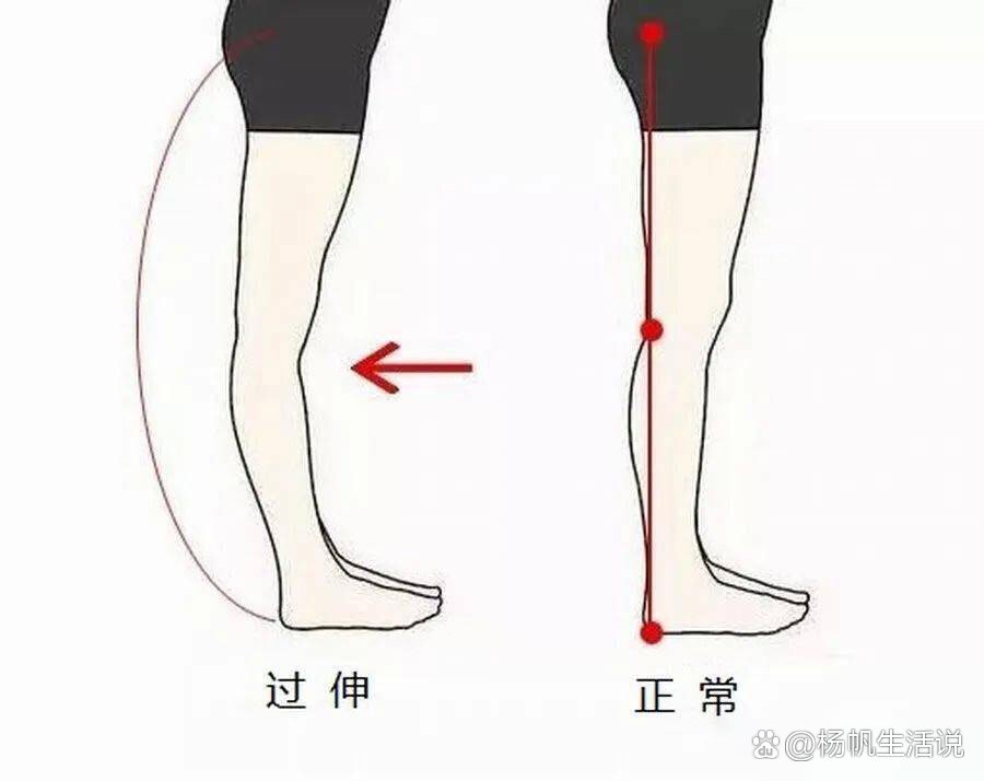 侧面看小腿弯曲,不直,该怎样拥有美丽的双腿