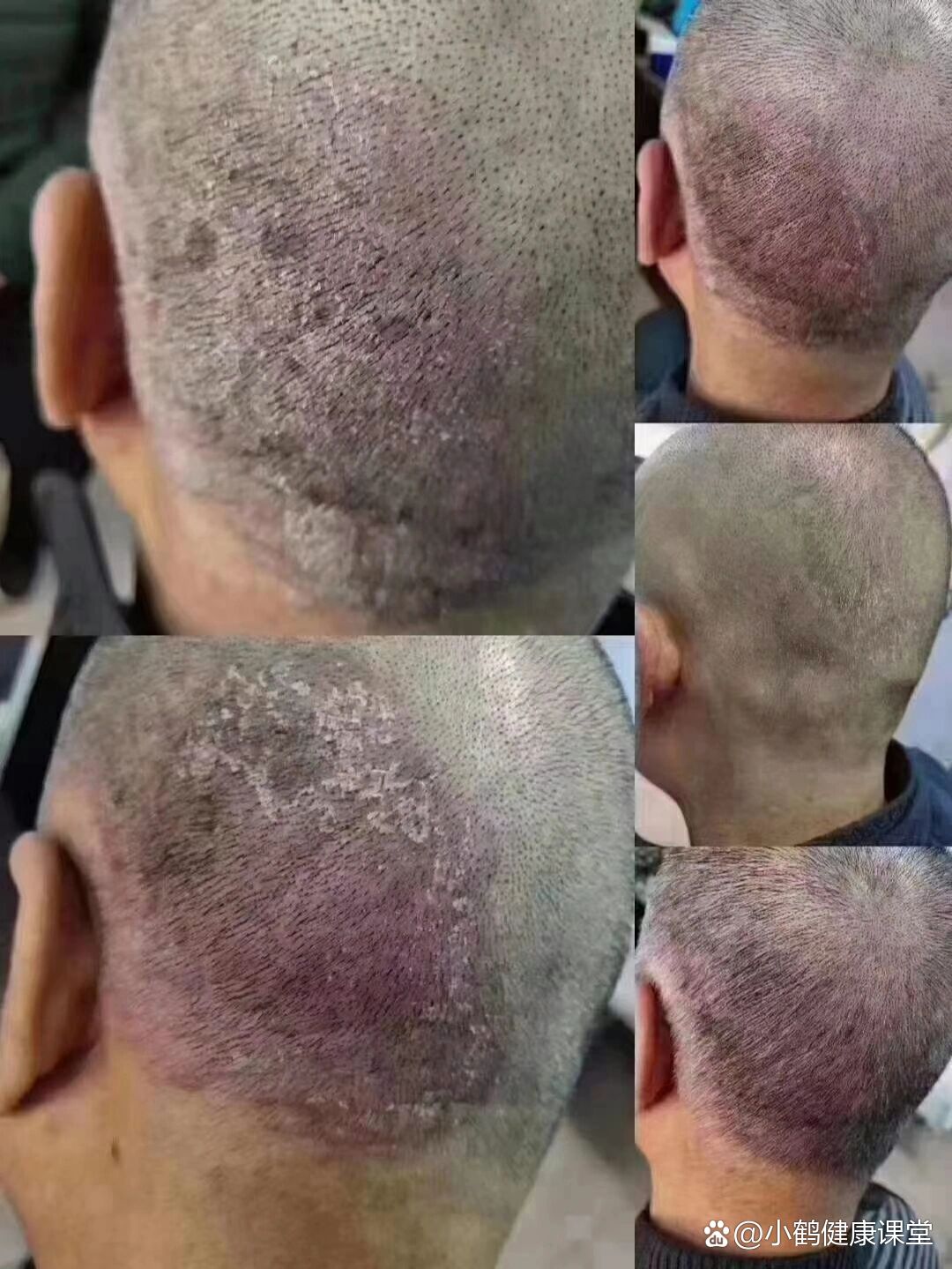 头部出癣的几种原因,一,熬夜,二,喝酒吸
