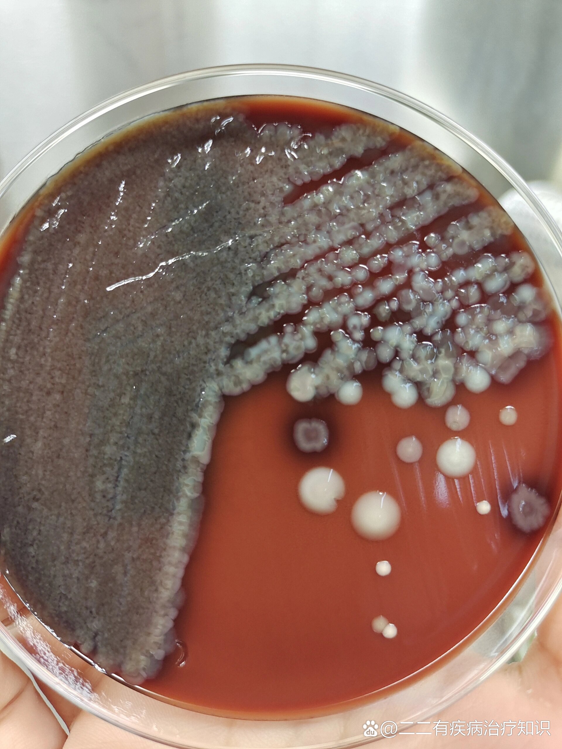 分享一例痰涂片,镜下可见大量革兰阴性杆菌