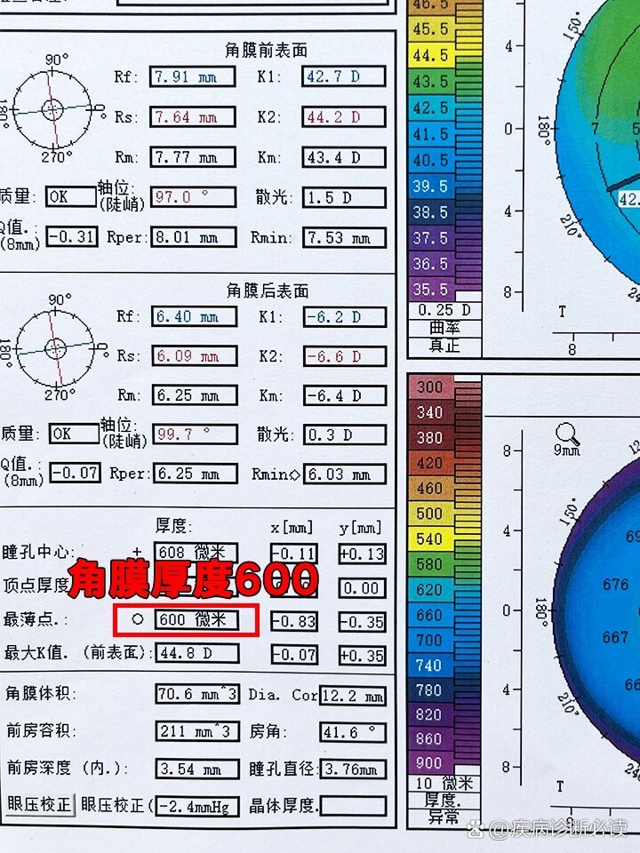 角膜厚度600,超过了大部分的人!