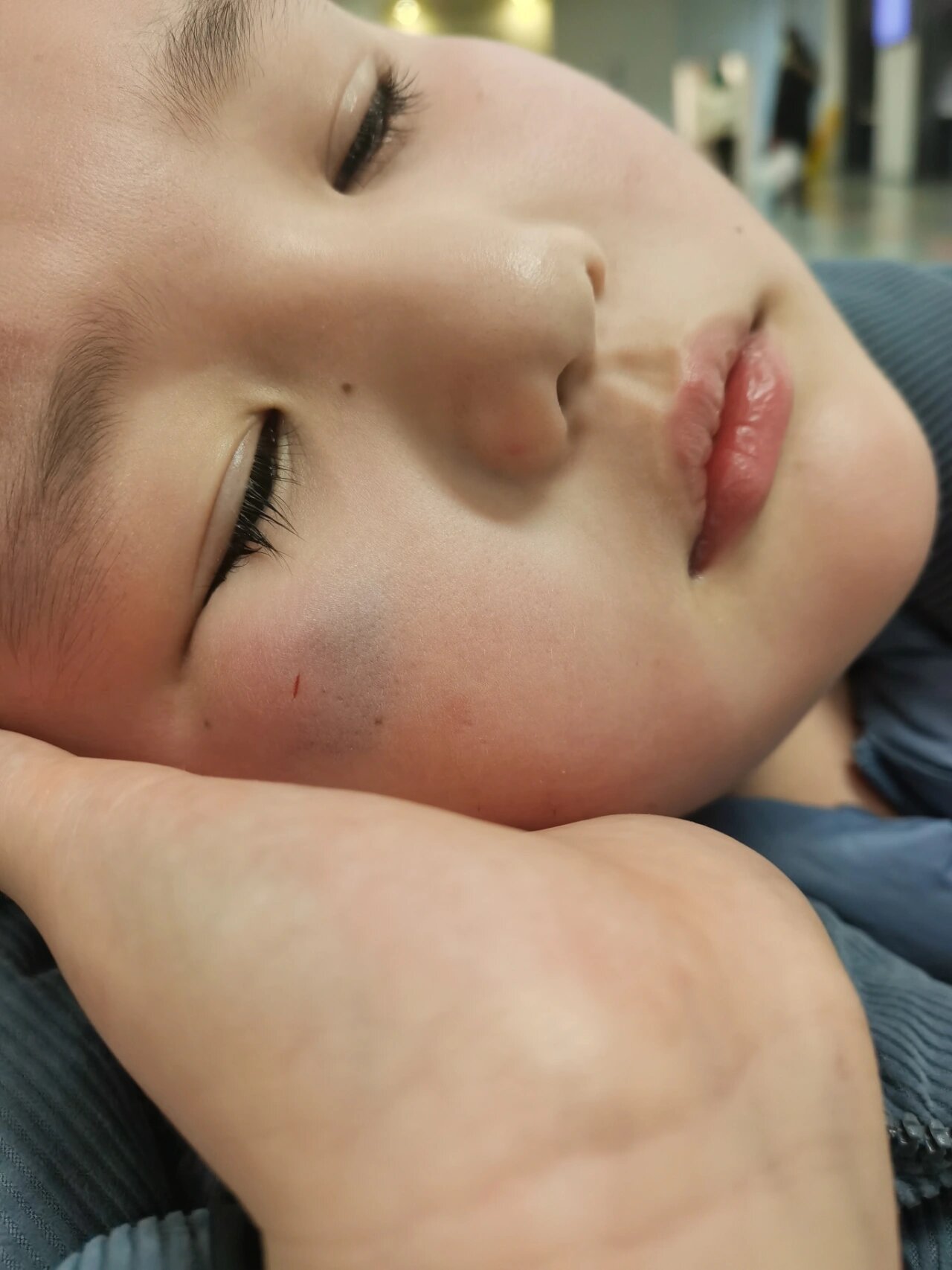 8岁外耳道胆脂瘤