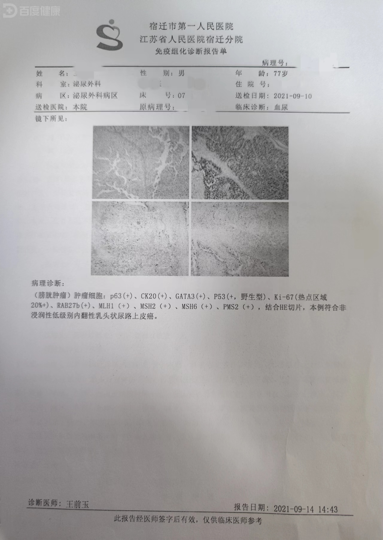 膀胱癌 病理报告图片