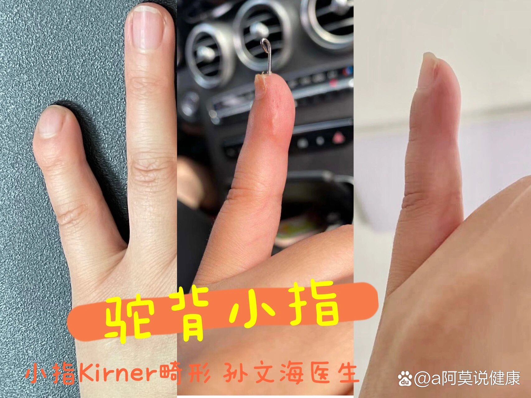 小指kirner畸形图图片