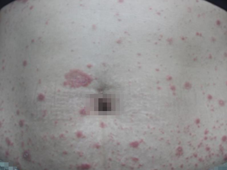 出现玫瑰色斑疹,斑丘疹,小心玫瑰糠疹