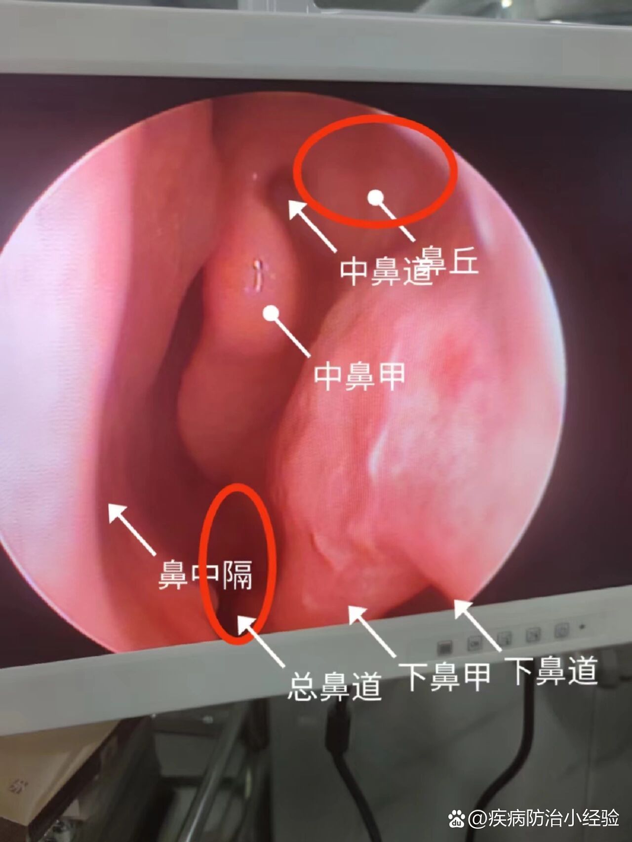 总鼻道图片