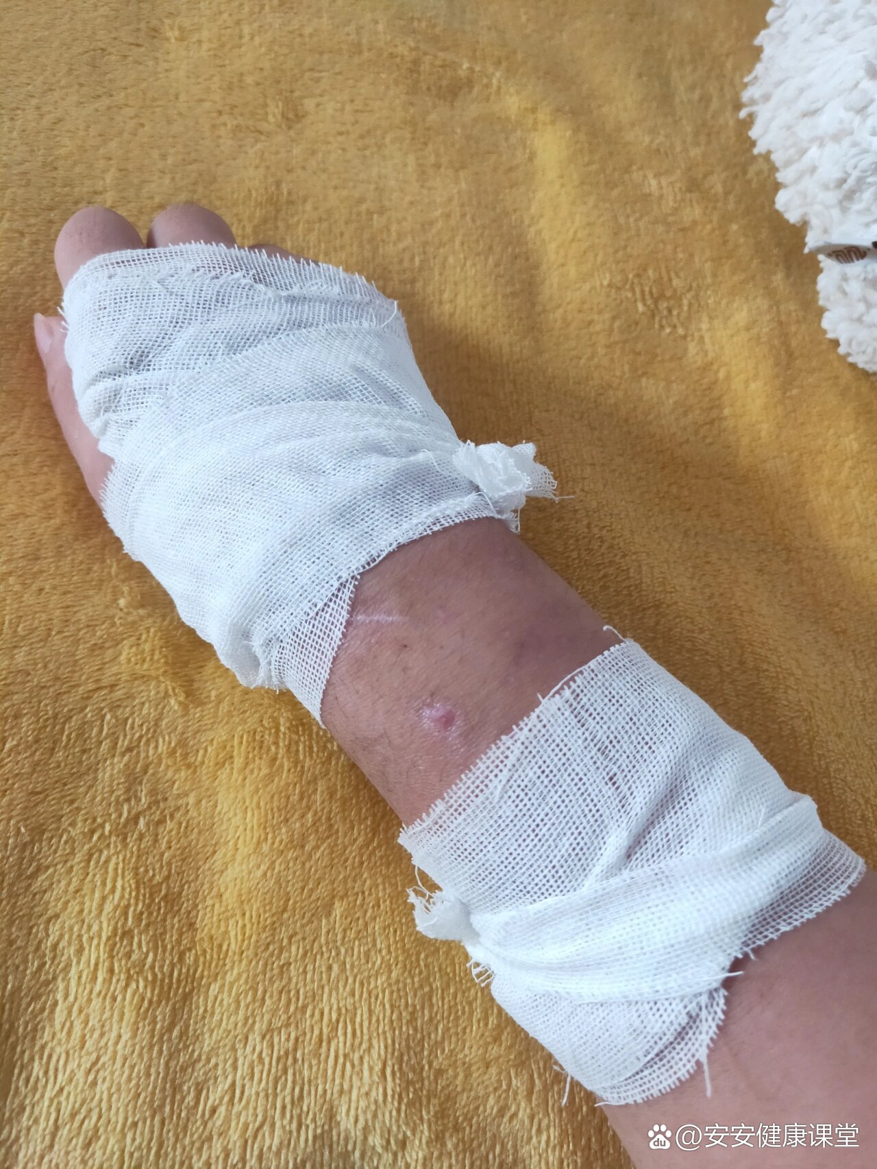 拆支架的第三天,伤口都愈合了