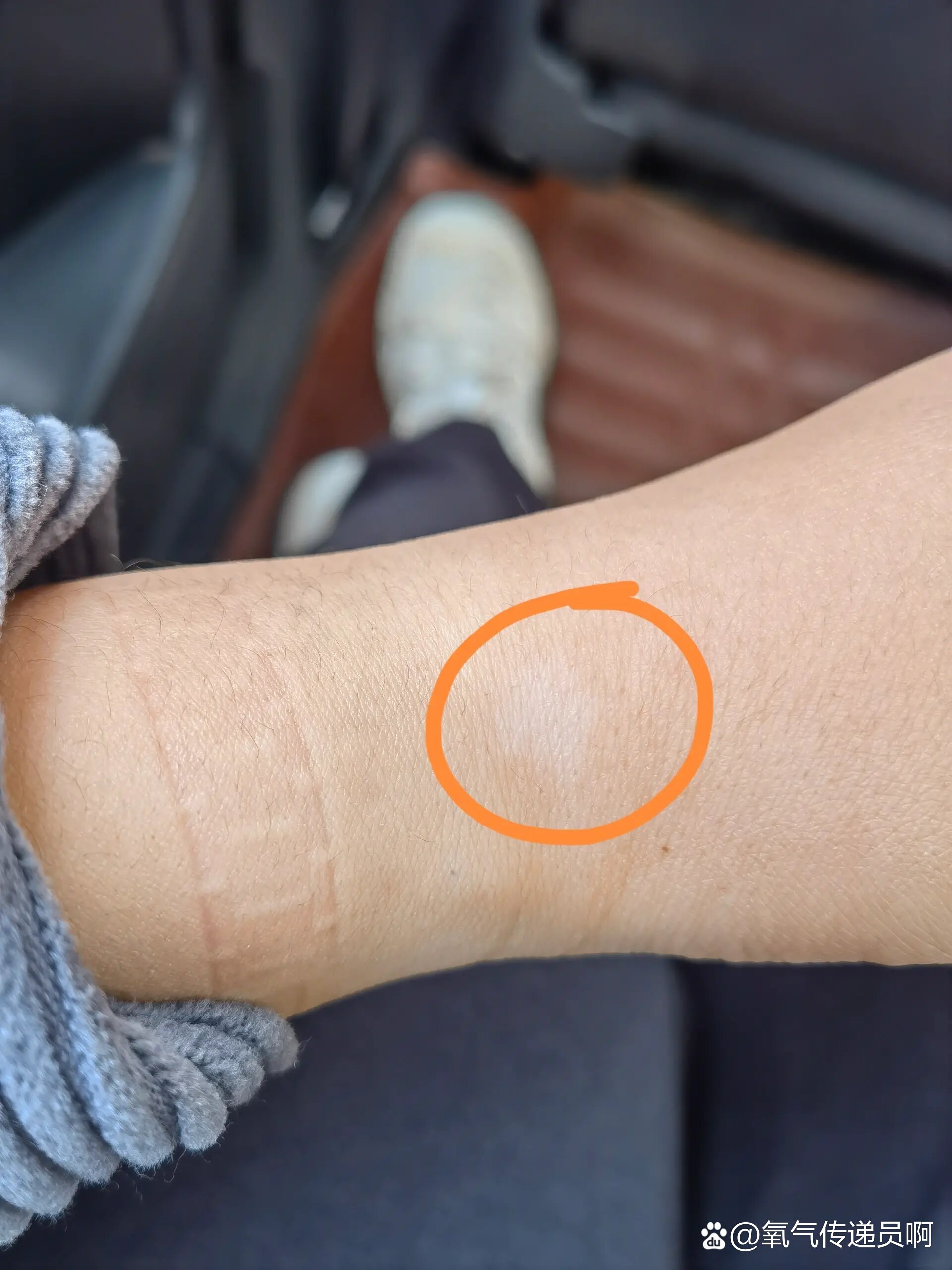 手腕上有一片白色