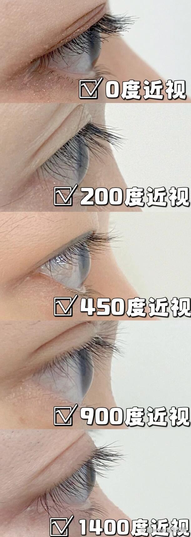 近视眼与正常眼睛外观图片