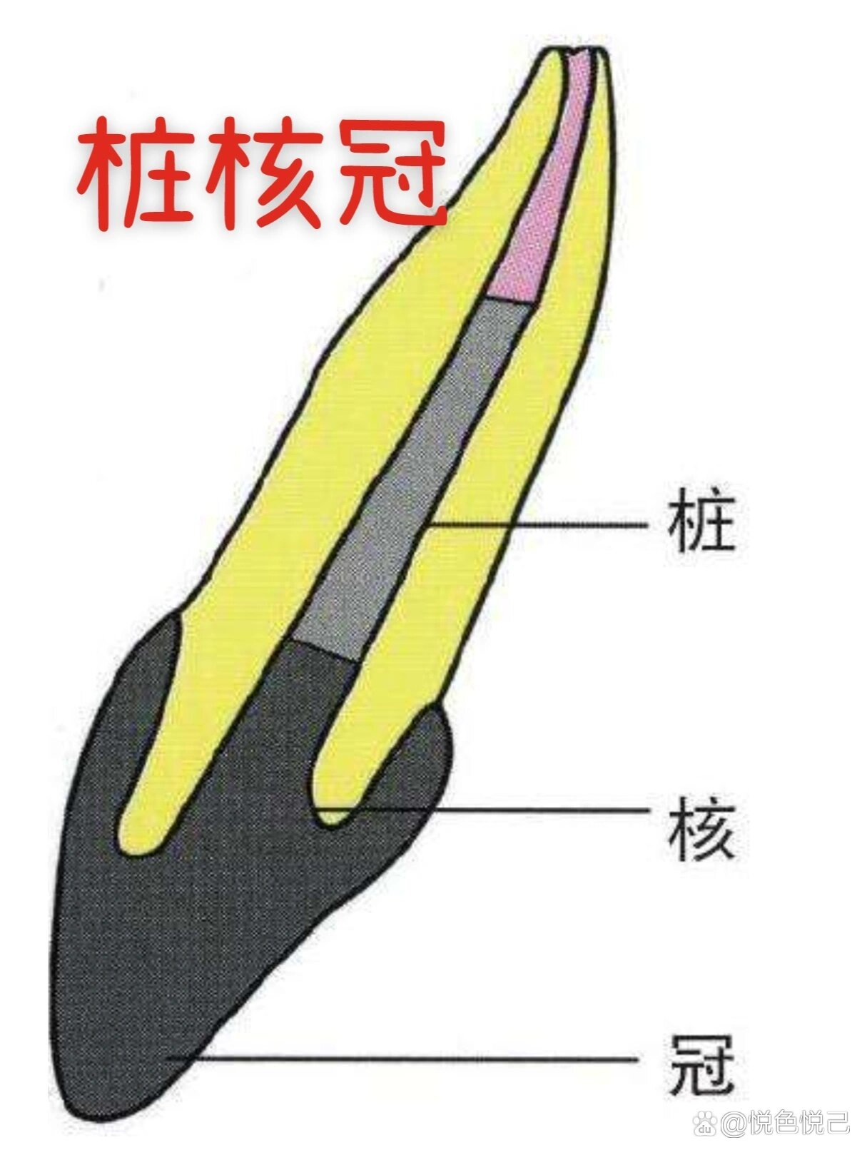 四分之三冠图片口腔图片