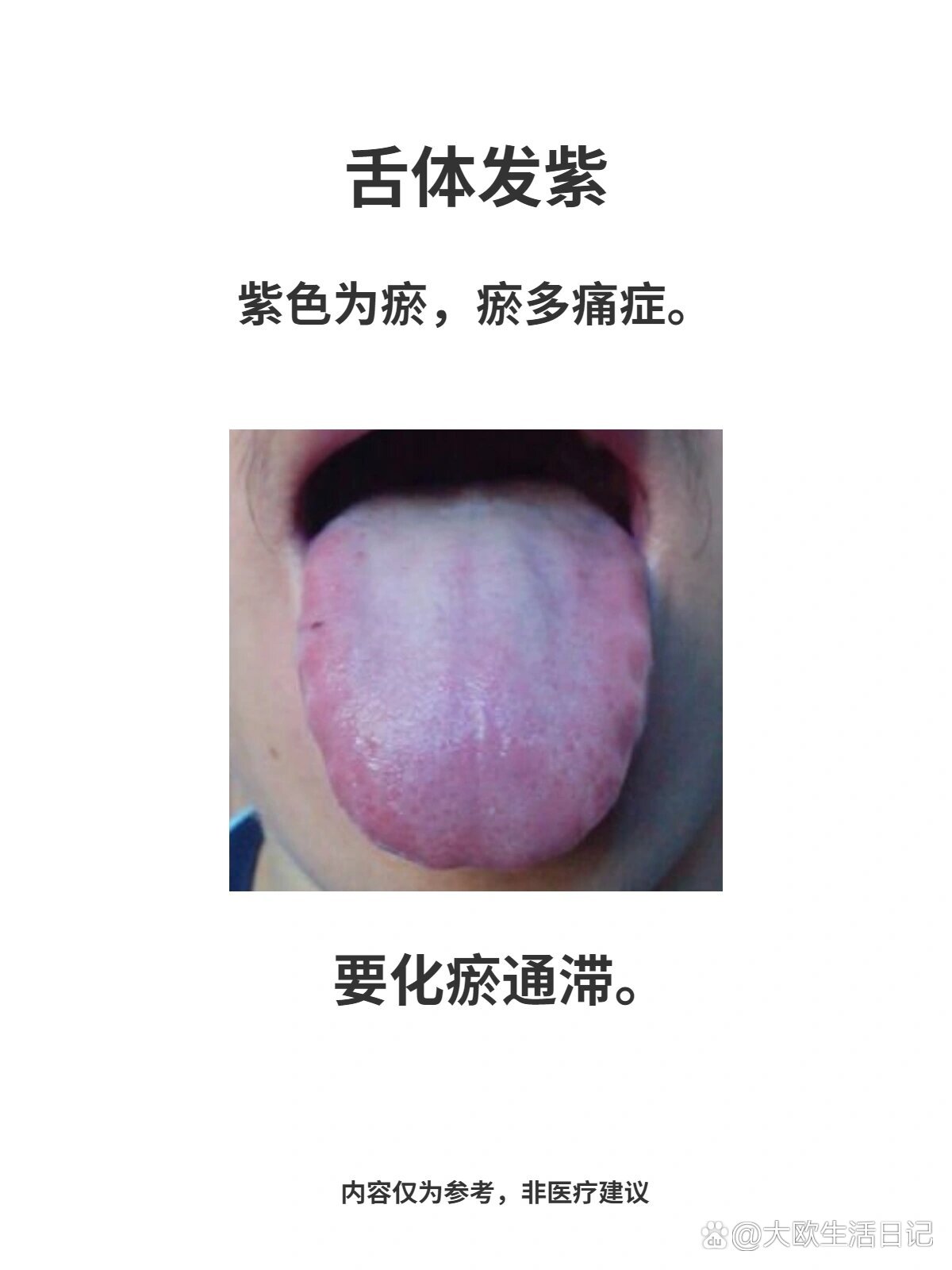 舌头发紫是什么病兆图片