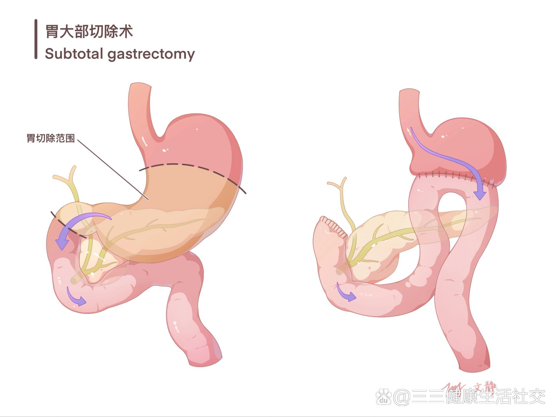 医学插画笔记‖胃大部切除术