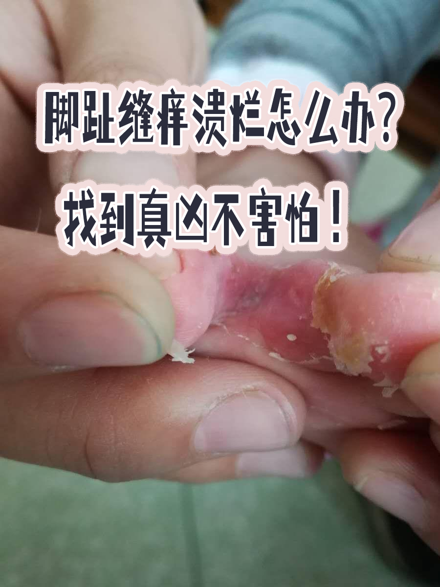 脚趾缝痒溃烂怎么办?找到真凶不害怕!