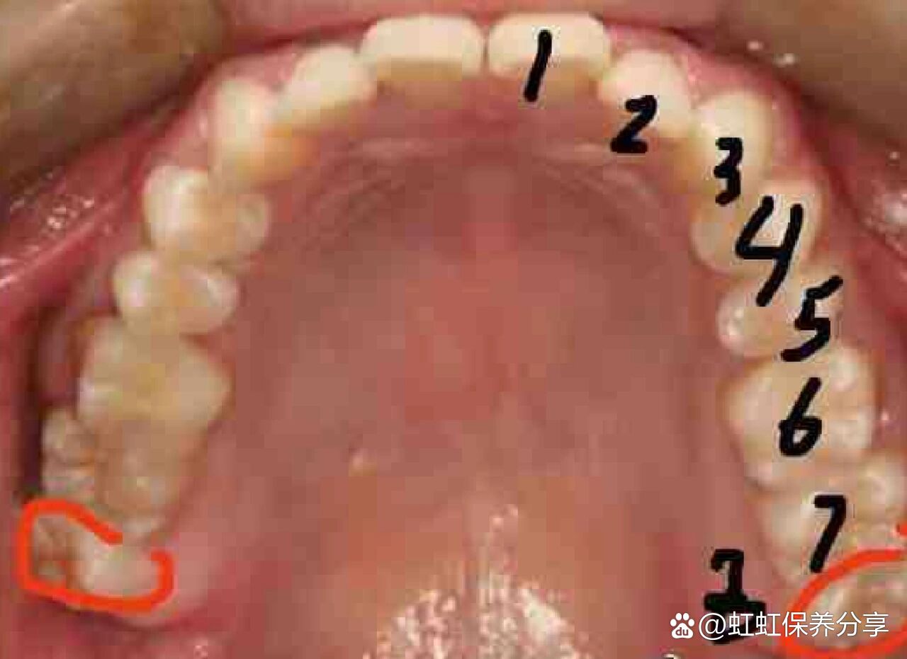 第三磨牙牙根图片图片