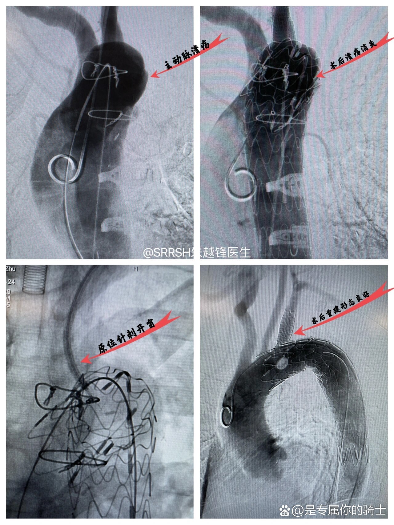 全天门诊,下午抽空顺手做了个主动脉弓部溃疡的腔内覆膜支架修复加左