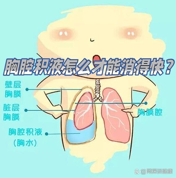 胸腔积液怎么才能消得快?