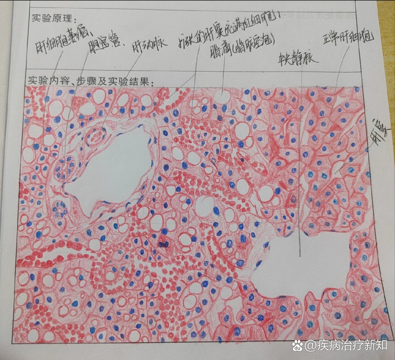 肝淤血图片带标注图片