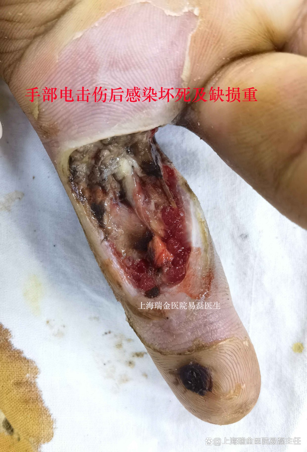 触电致电烧伤手部,手软组织缺损和感染坏死,修复整形后恢复如初
