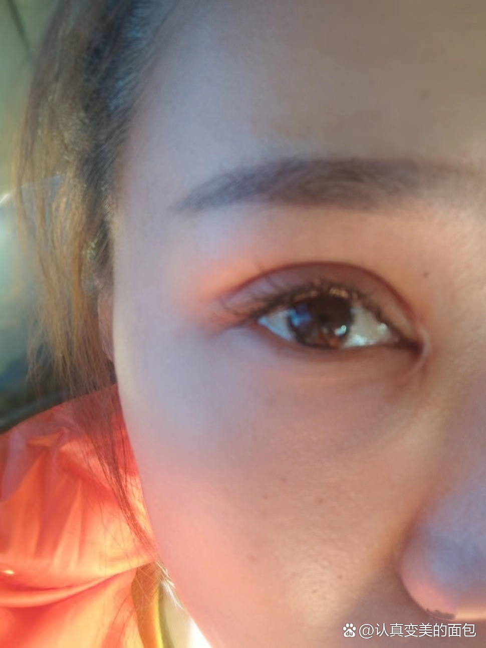 为什么10个开内眼角9个留疤?