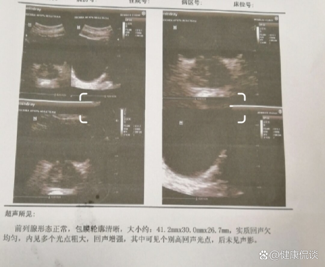 前列腺正常彩超图图片