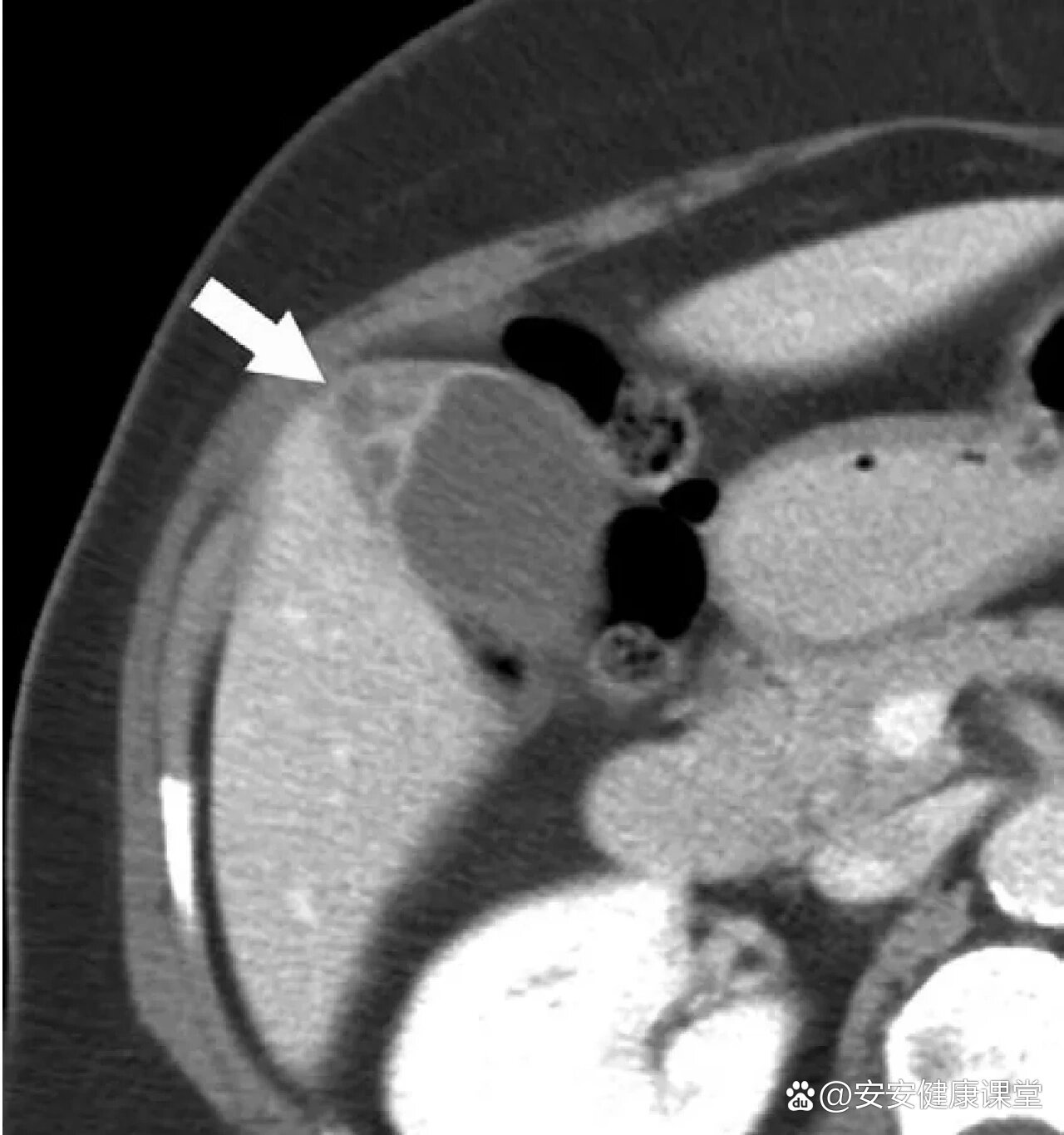 胆囊区解剖&胆囊腺肌症,建议收藏❤️