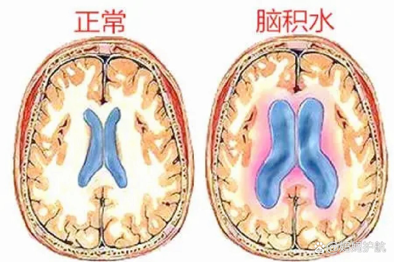 婴儿脑积水有哪些症状图片