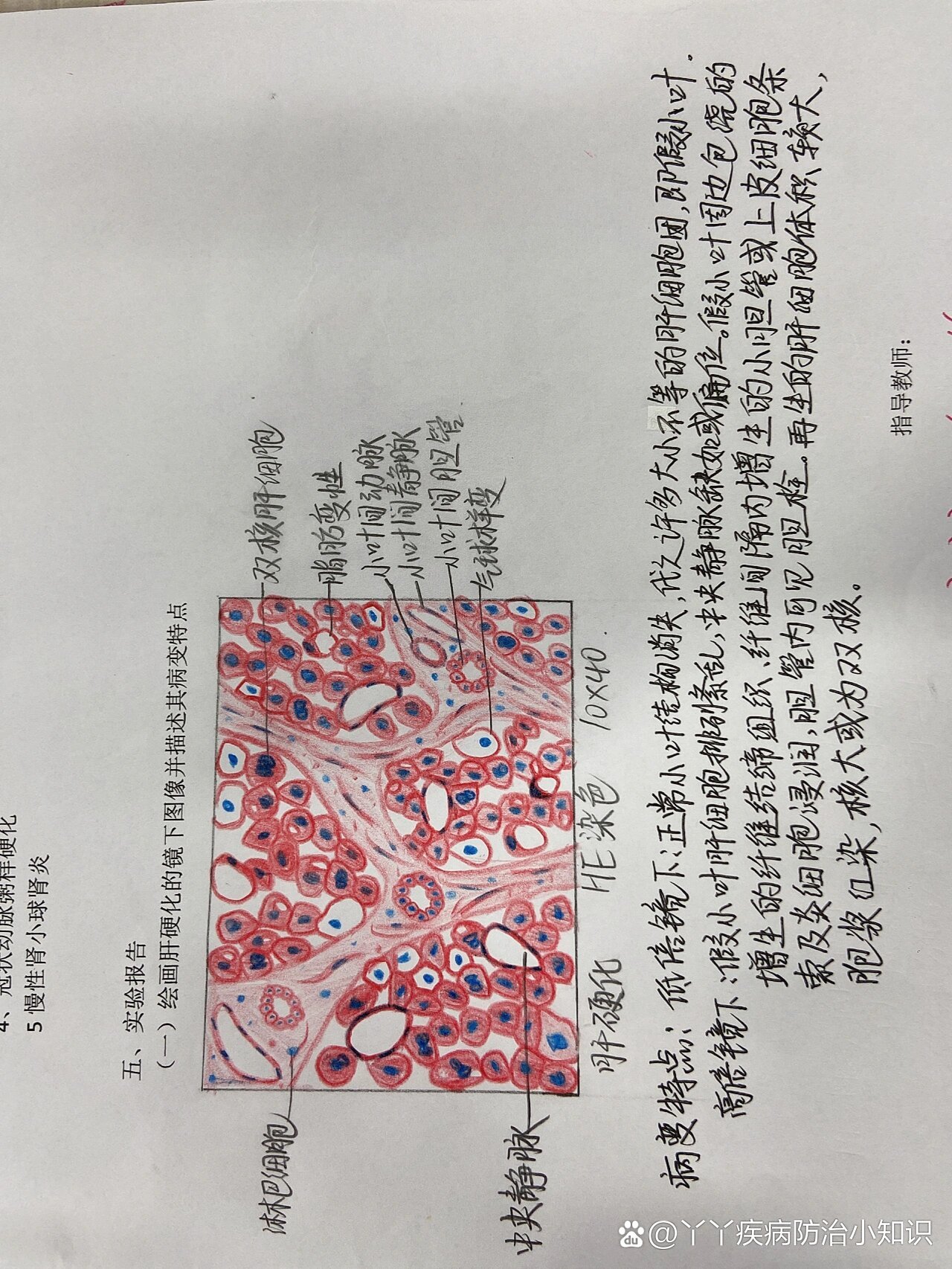 肝硬化手绘图实验报告图片