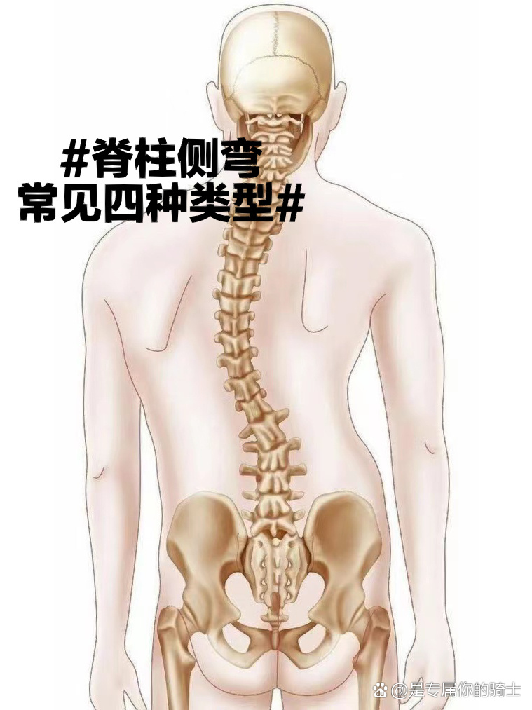 脊柱侧弯lenke分型图谱图片