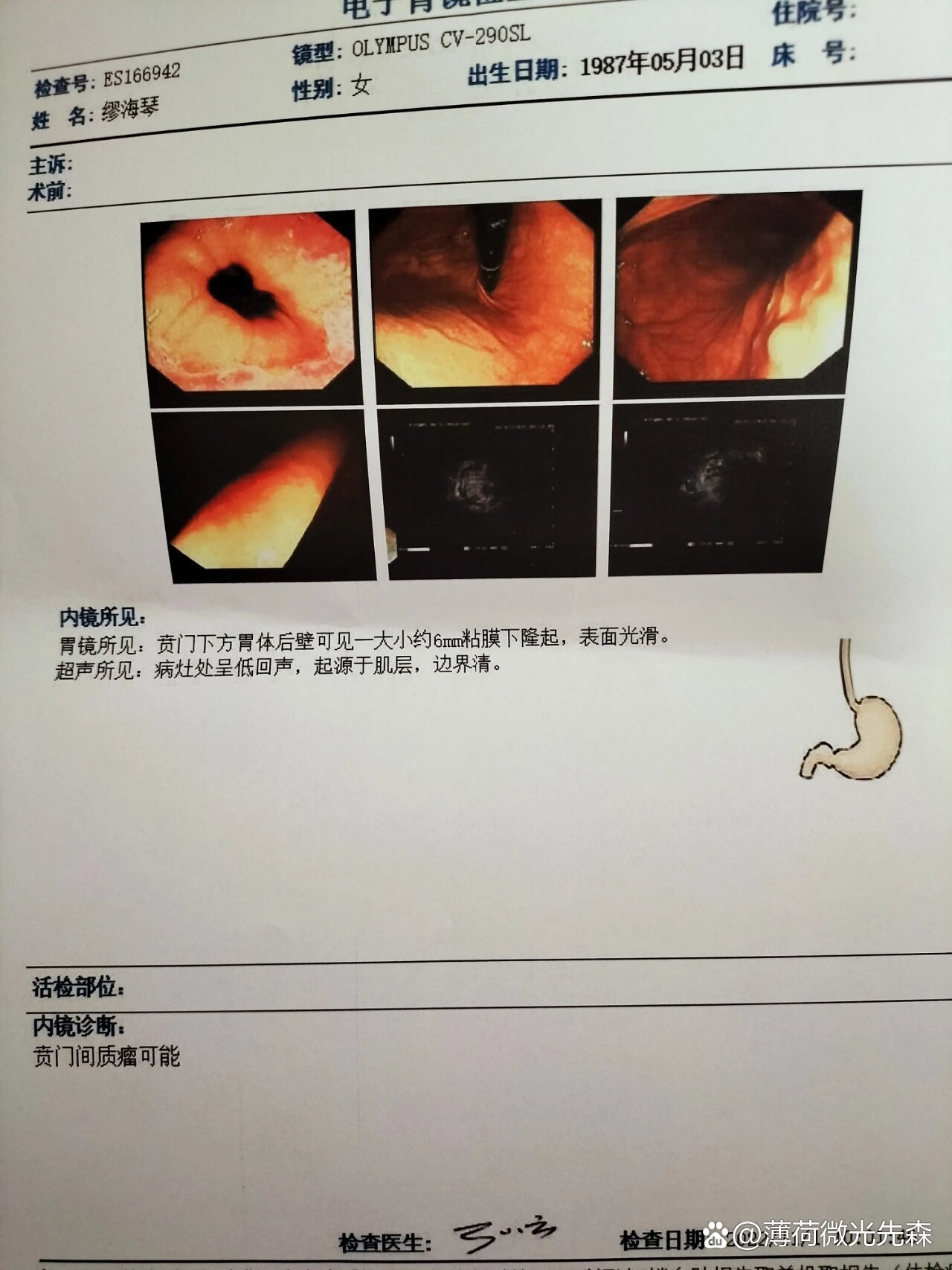 胃间质瘤超声图片