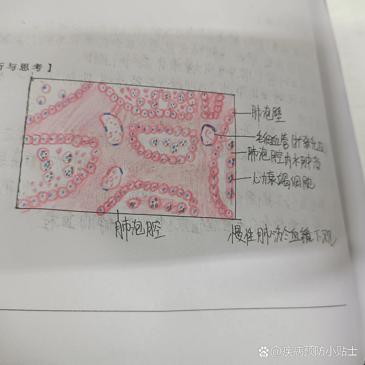 肺淤血切片手绘图图片