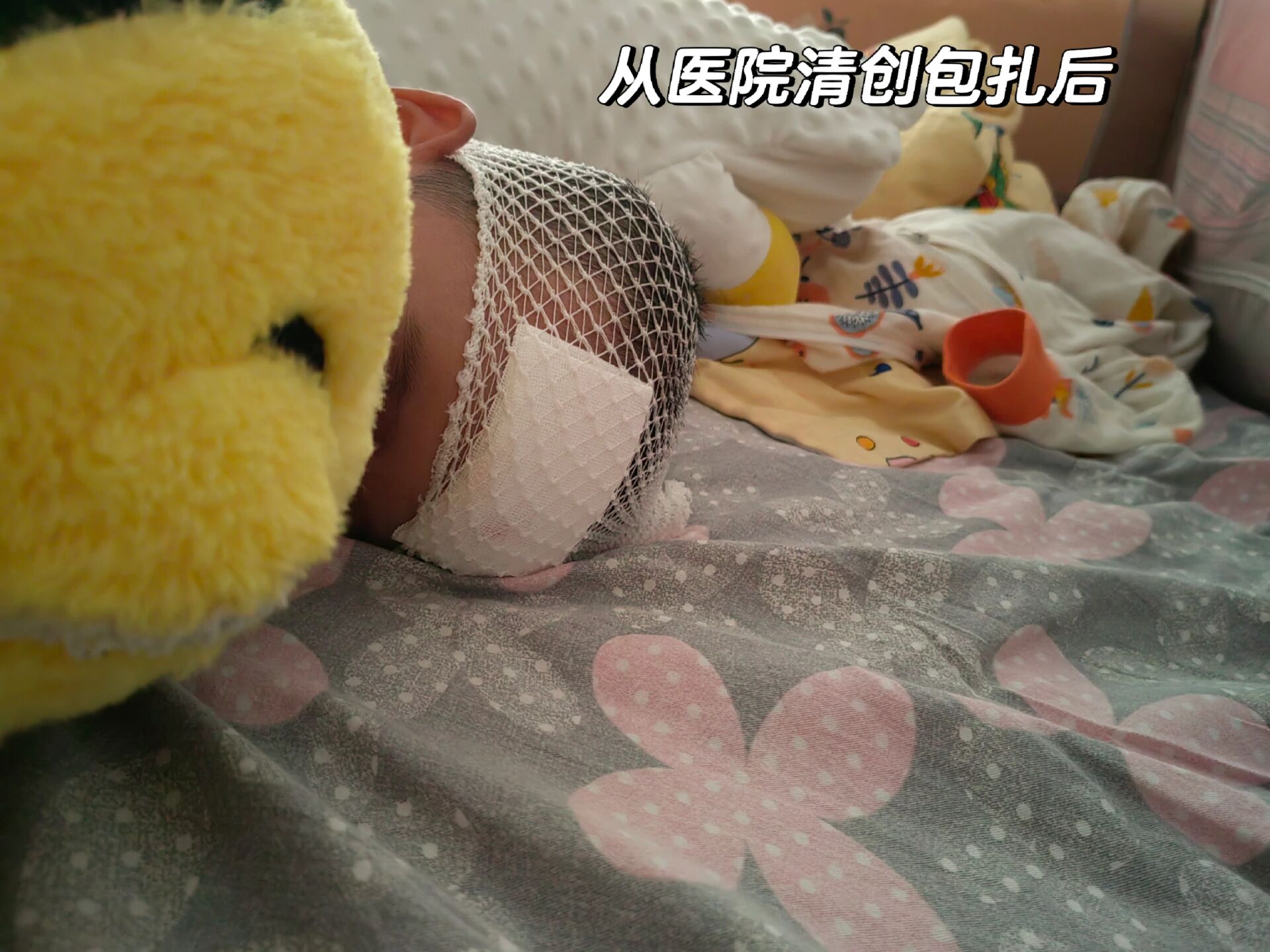 小朋友意外磕破头皮或擦伤如何初步处理