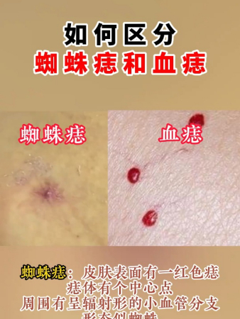 如何区分蜘蛛痣和血痣,看不懂的要仔细看了!