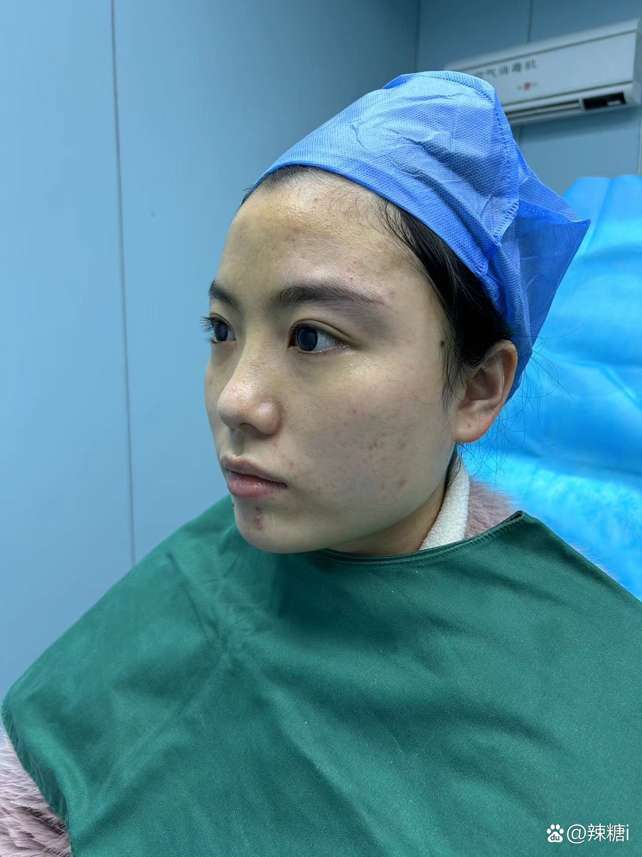 鼻翼整形大概多少钱_鼻翼整形术_鼻翼整形手术