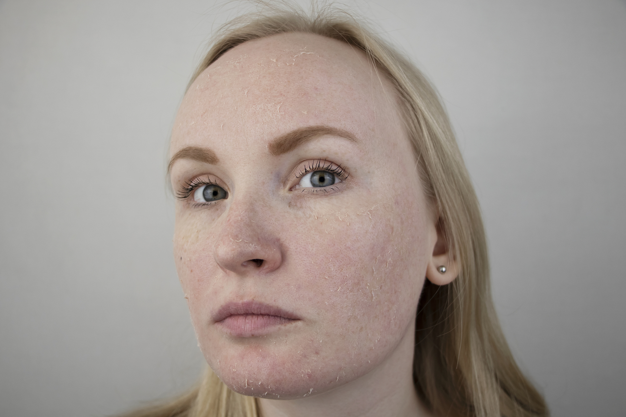 玻尿酸注射101:告别干燥,松弛等肌肤问题!