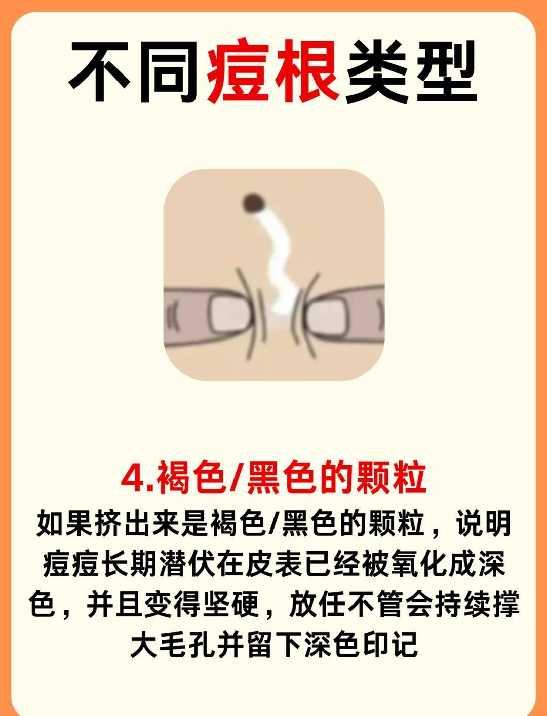 痘痘根类型自测：你是哪种痘根？
