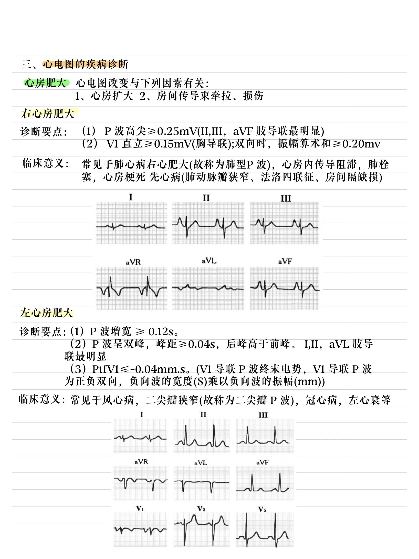 左房增大心电图图片