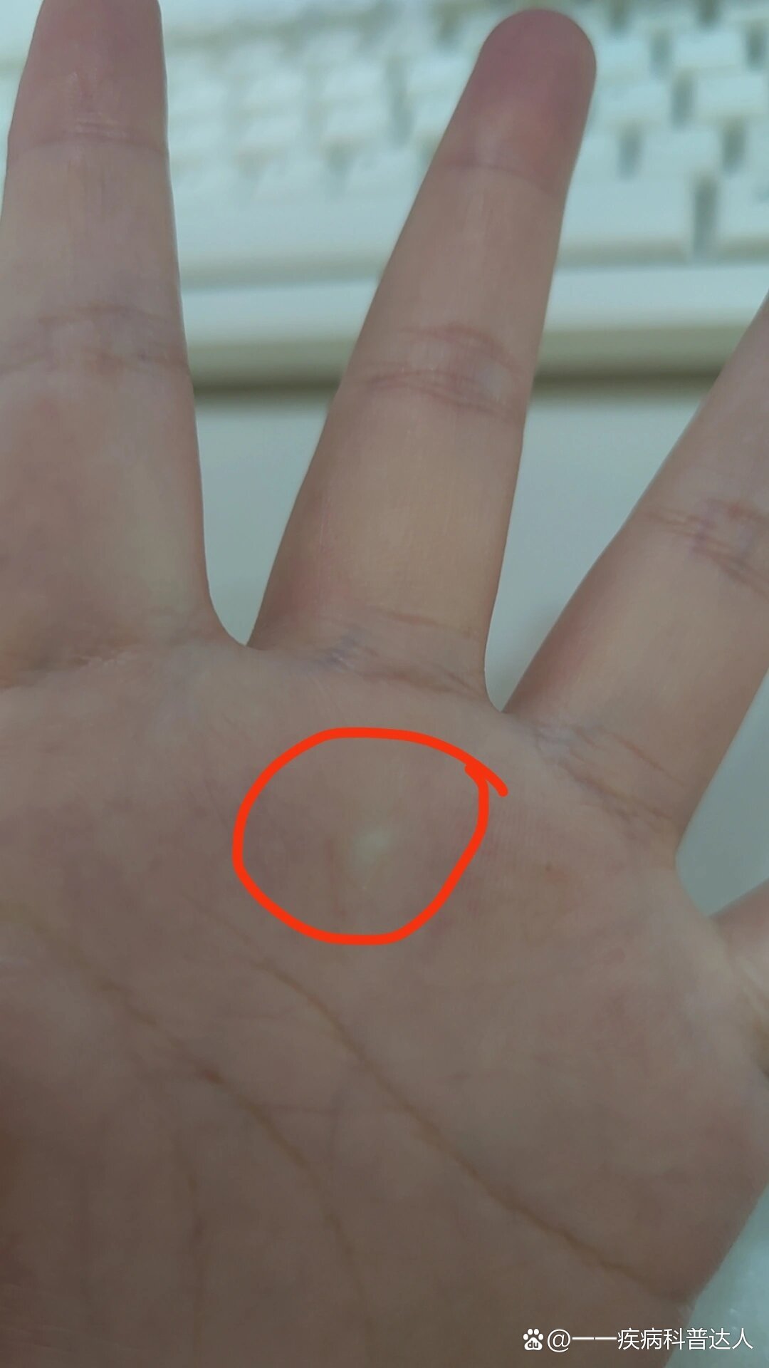 掌心上面莫名其妙长了一个硬硬的鼓鼓的包