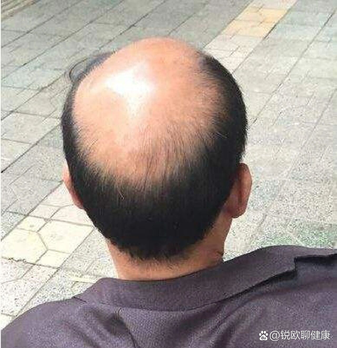 男性头顶秃头是什么原因造成的?