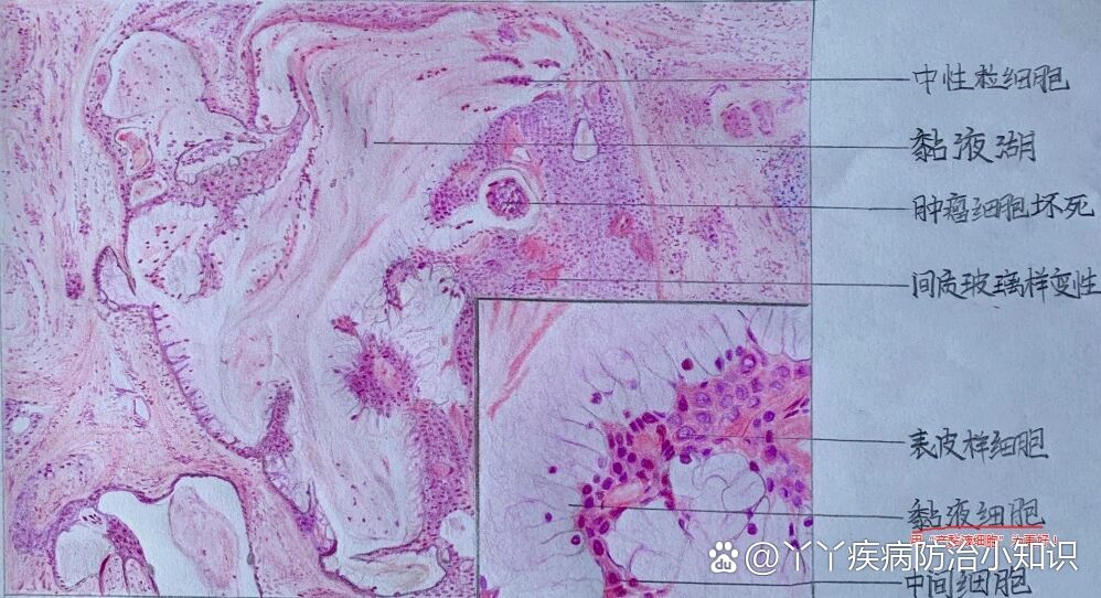 口组病绘图·黏液表皮样癌