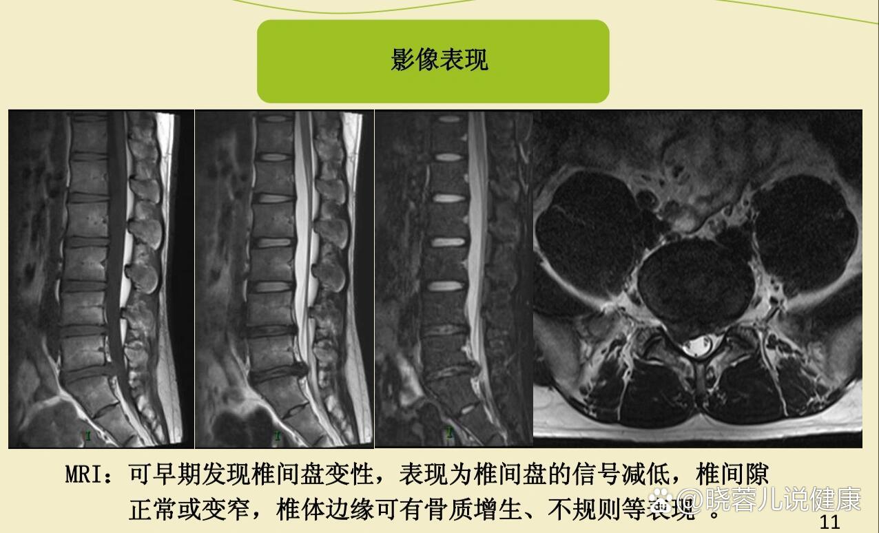 腰间盘突出ct图片对比图片