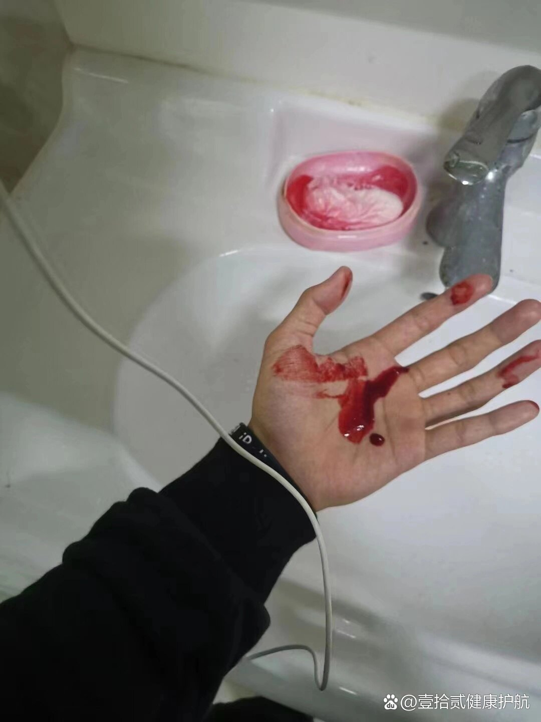 抠鼻子扣得流鼻血