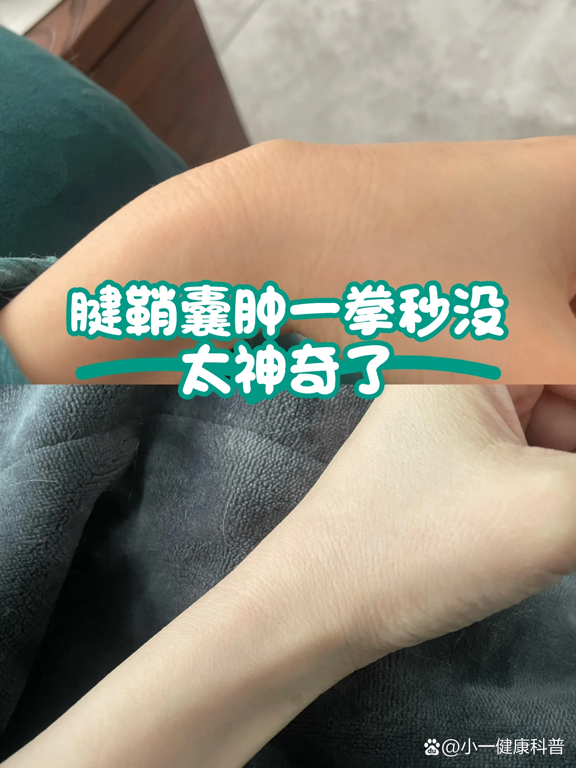 腱鞘囊肿开刀前先找人打一拳